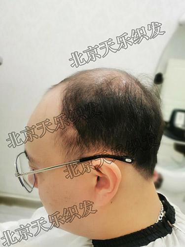秃顶侧面2